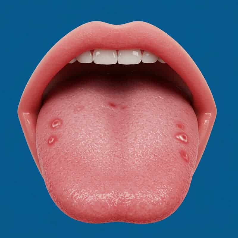18. Swollen, Smooth Tongue