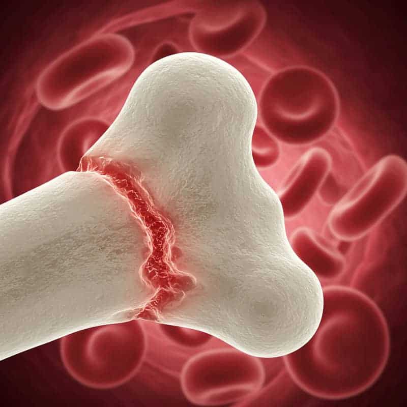 44. Easy Fracturing of Bones